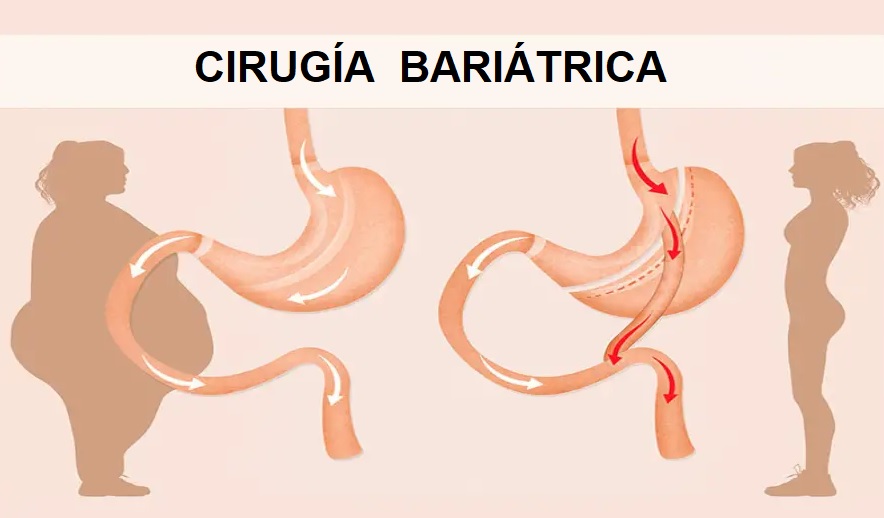 Menos trabas para acceder a una cirugía Bariátrica (Guía NICE).