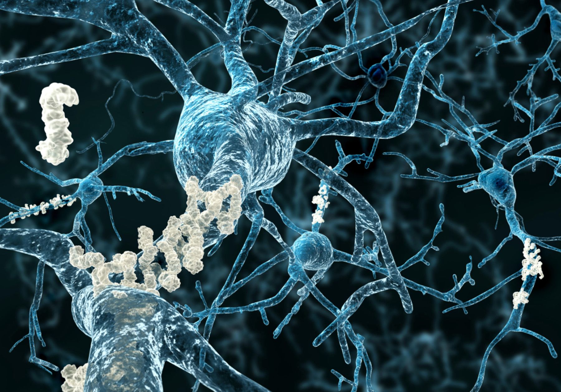 El estudio Lecanemab. ¿Es la placa amiloide el problema del Alzheimer?