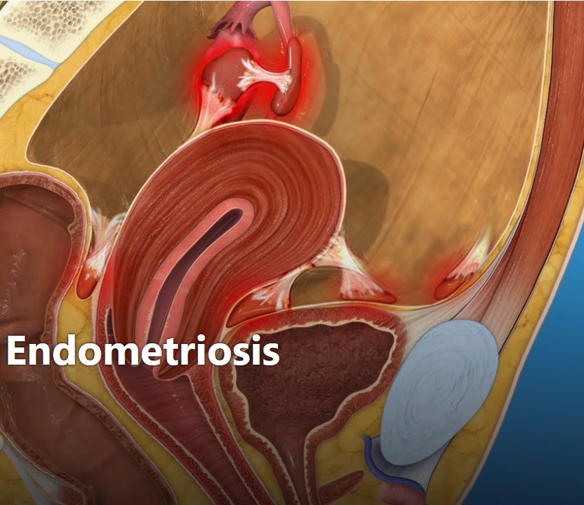 Endometriosis