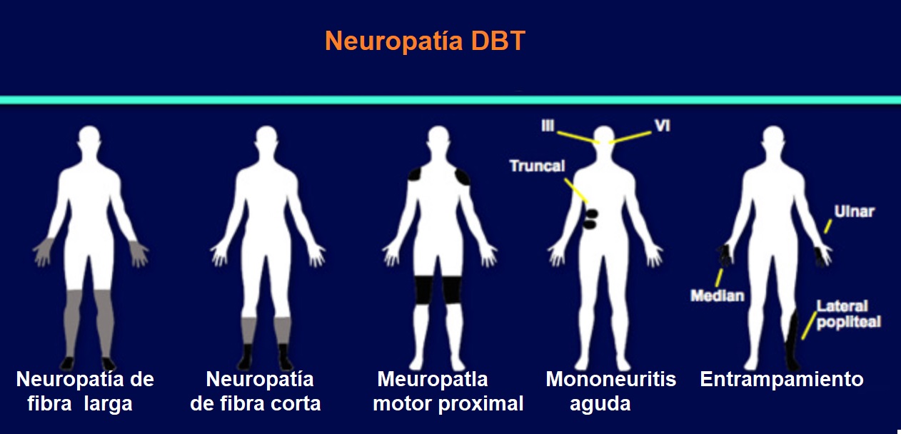 Neuropatía DBT.
