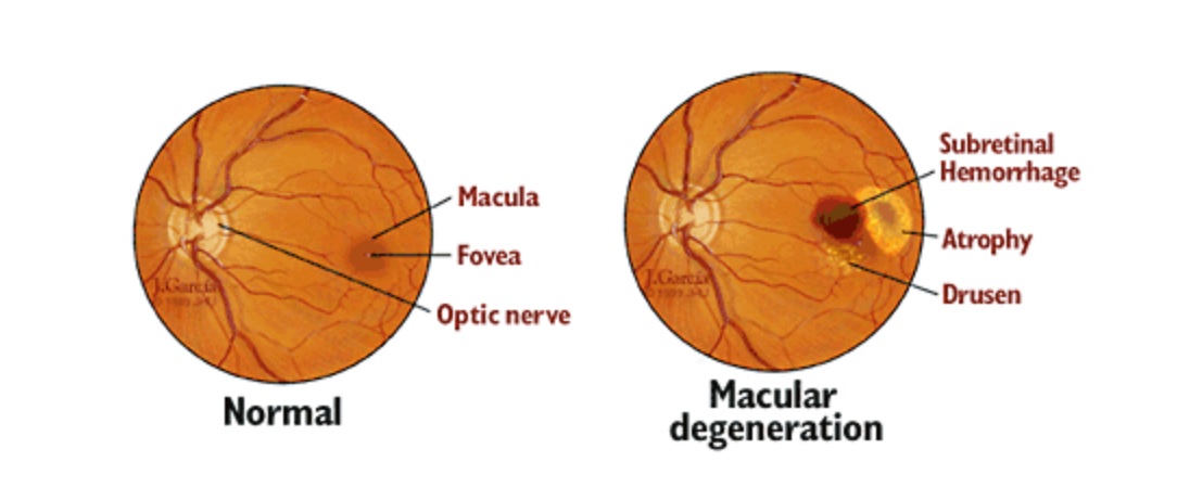Degeneración macular relacionada con la edad.