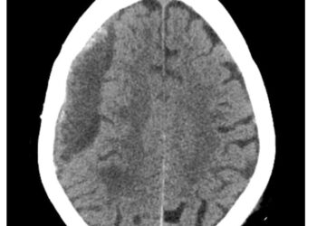 Hematoma subdural.