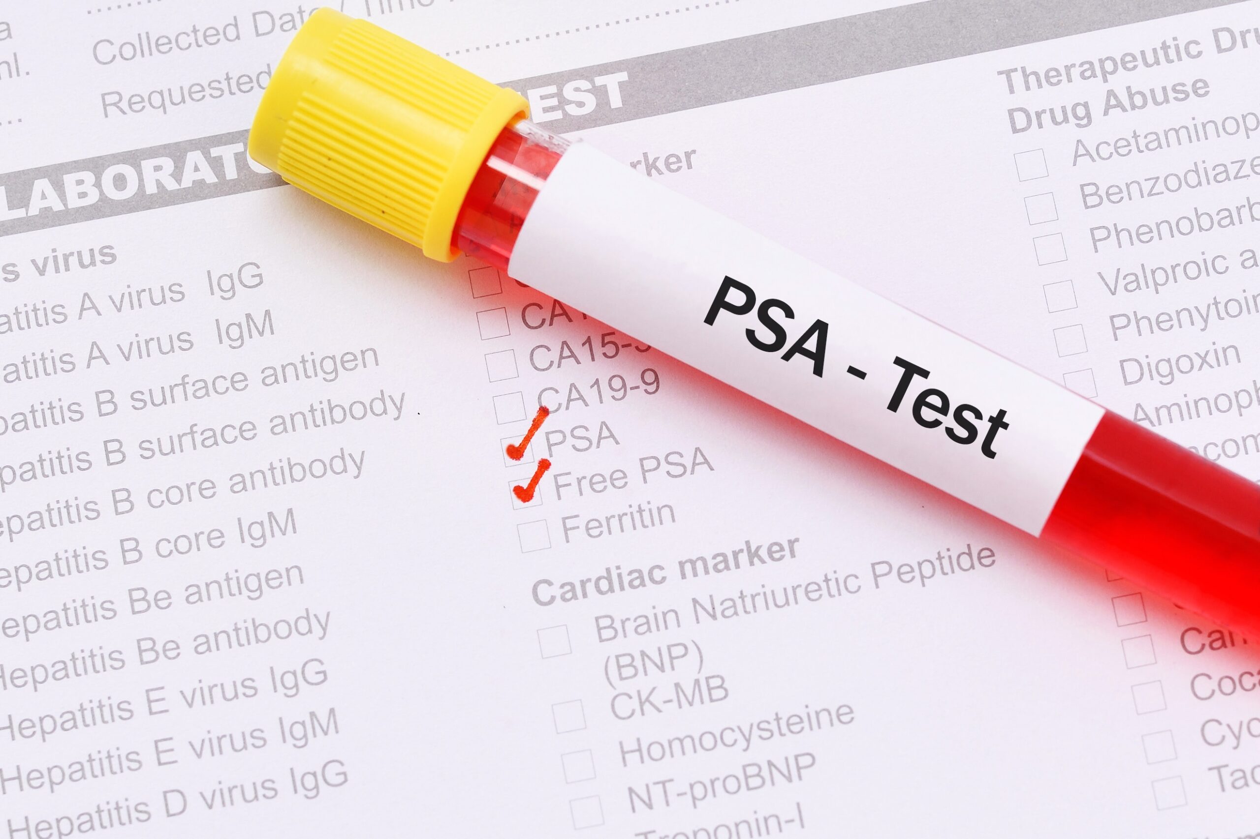 ¿Se debería seguir pidiendo PSA en personas asintomáticas?