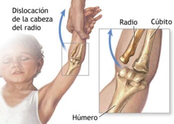 Codo “de niñera”