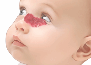 Hemangiomas Infantiles